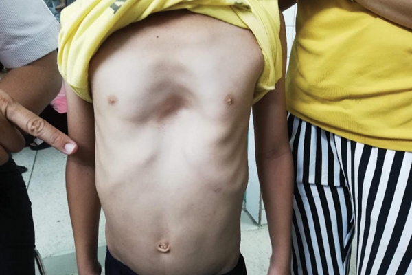 Vết lõm xương cùng - Hình ảnh minh họa